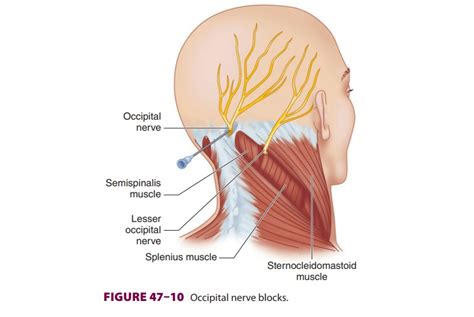 Occipital Nerve Block