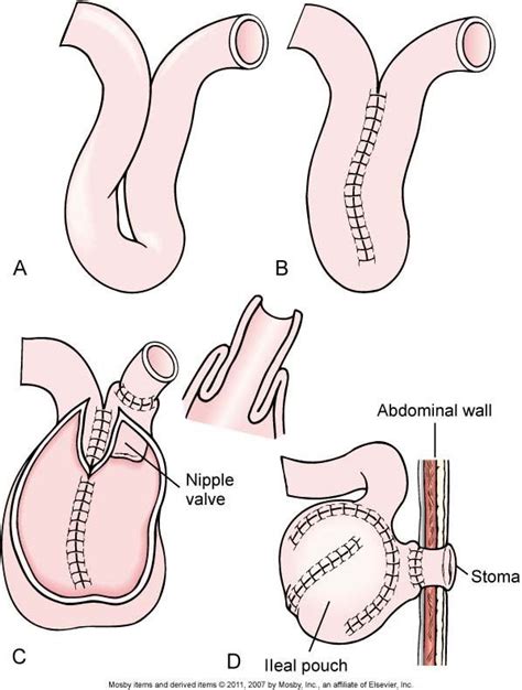 Pin on Ostomy