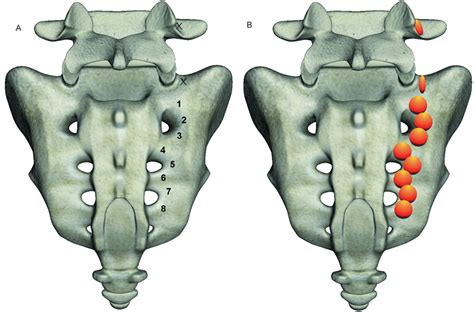 Sacroiliac Joint Nerve Block