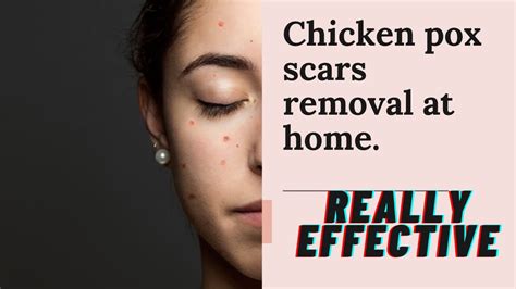 How to remove chicken pox spots at home -chicken pox scars removal - YouTube