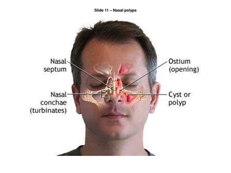 Nasal Polyps Anatomy