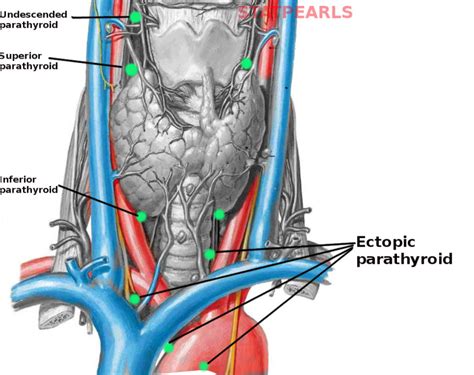 [Figure, Ectopic parathyroid glands Image courtesy S Bhimji MD] - StatPearls - NCBI Bookshelf