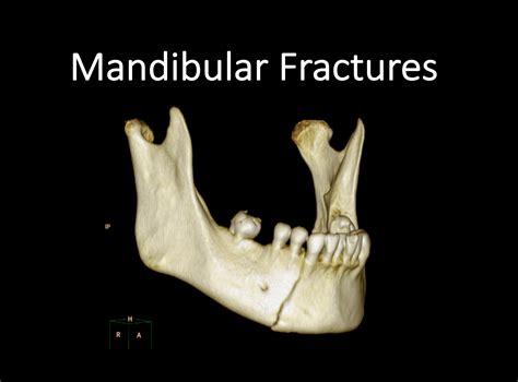 Mandible Fracture Treatment