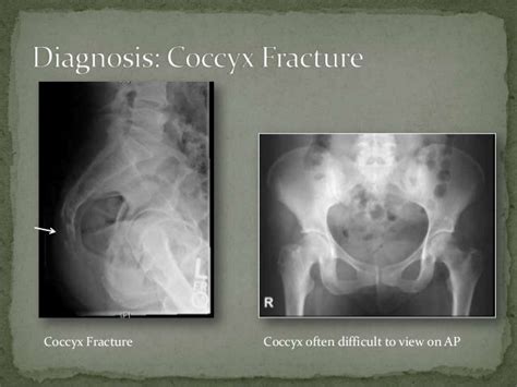 Coccyx Fracture