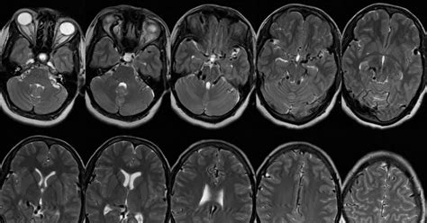 Dr Balaji Anvekar FRCR: Dural Arteriovenous Fistula (Dural AVF) MRI