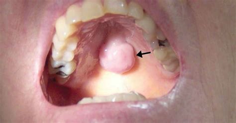 Torus Palatinus : Penyebab – Gejala dan Pengobatan - IDN Medis
