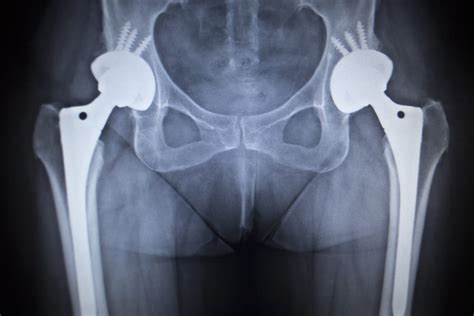 Hip replacement surgery improves symptoms and biomechanics -- but not physical activity | The ...