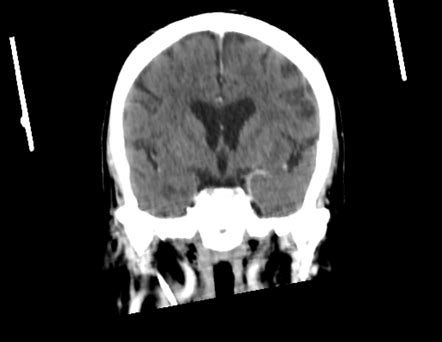 Optic nerve sheath meningioma - axial exophthlmos grade 3 | Image | Radiopaedia.org