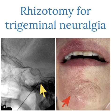 Trigeminal Neuralgia Treatment