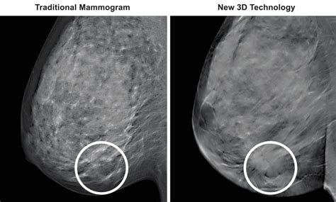 3D Mammography (TM) - Medical Associates of Northwest Arkansas