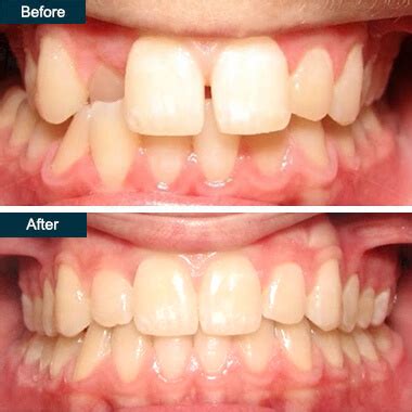 Overlapping Teeth | Can Invisalign Treatment Fix Crowded Teeth?