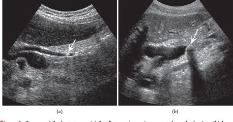 Common Bile Duct Stone Ultrasound