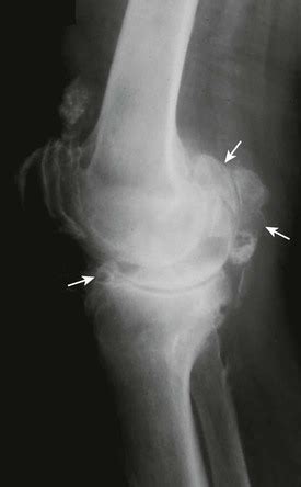 Flexion Contracture Associated with Total Knee Arthroplasty ...