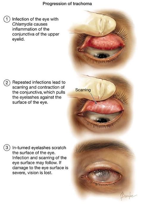 29 best Eye Diseases images on Pinterest | Eye facts, Contact lenses color and Eye contact lenses