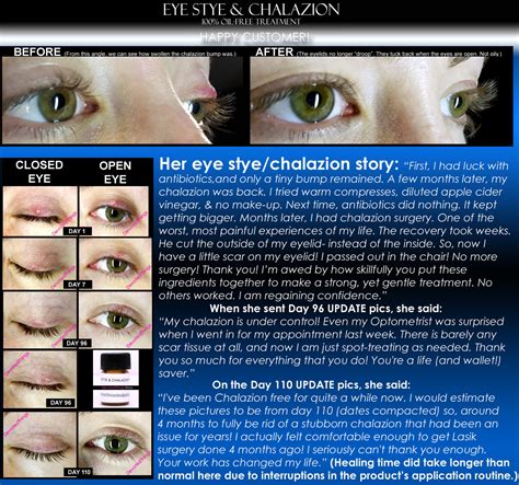 4 Before and After Eye Stye and Chalazion | Grelly USA