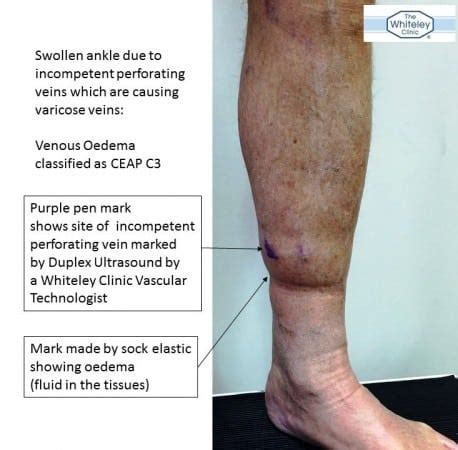 Swollen ankle from incompetent perforator veins - The Whiteley Clinic