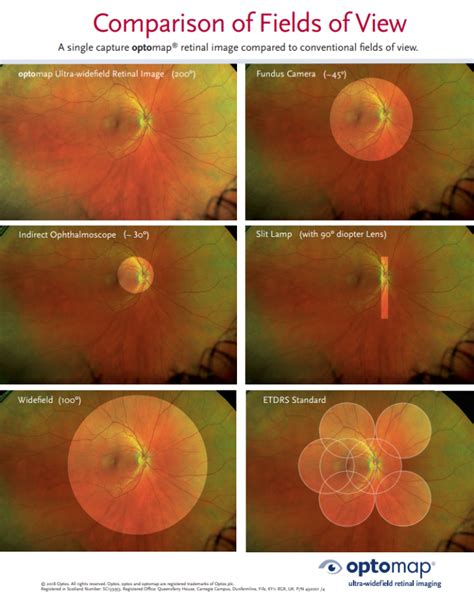 Optimal Retina Imaging | Eye Test Exam | Eye Care Orangeville