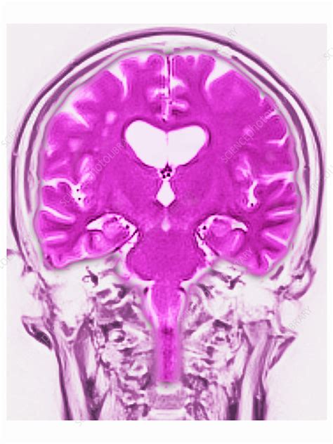 Brain MRI, White Matter Hyperintensities - Stock Image - C027/1268 - Science Photo Library