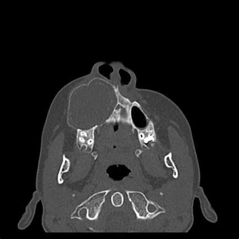 Maxillary odontogenic keratocyst | Radiology Case | Radiopaedia.org | Radiology, Head and neck ...