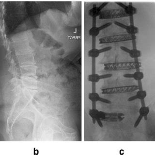 Illustrations comparing the LLIF (a) and OLIF (b) approaches. Note how... | Download Scientific ...