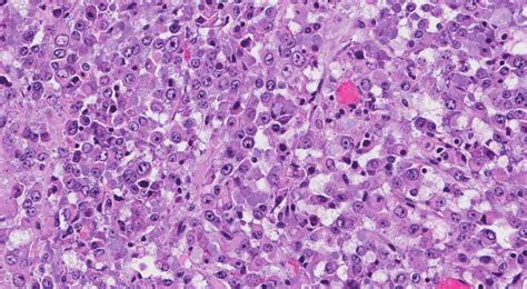 Epithelioid sarcoma | Ottawa Atlas of Pathology