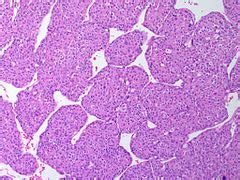 Adrenocortical carcinoma - Libre Pathology