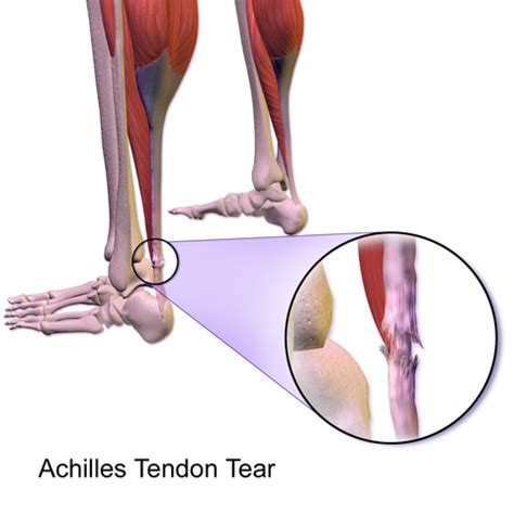 Achilles Tendon Tear