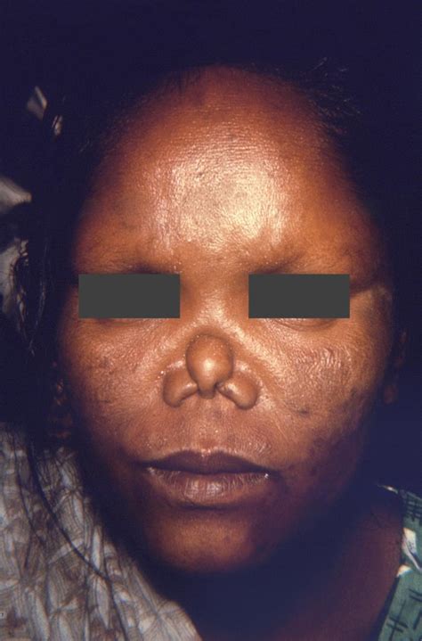 Leprosy physical examination - wikidoc