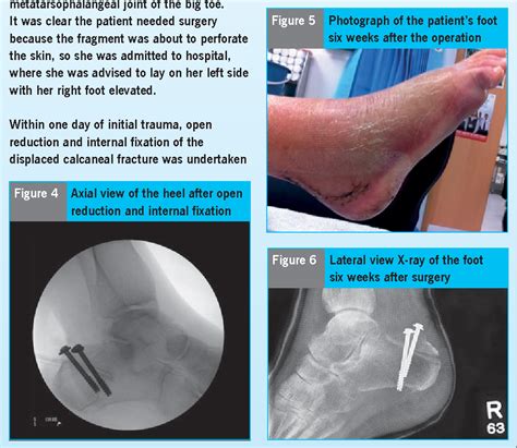 Figure 6 from Avulsion fracture of the calcaneal tuberosity: diagnosis ...