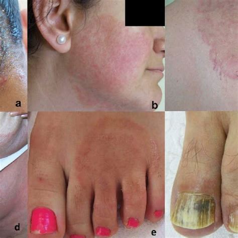 Clinical manifestations of dermatophyte infections. Full color... | Download Scientific Diagram