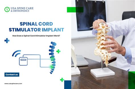 How Does a Spinal Cord Stimulator Implant Work? - USA Spine Care