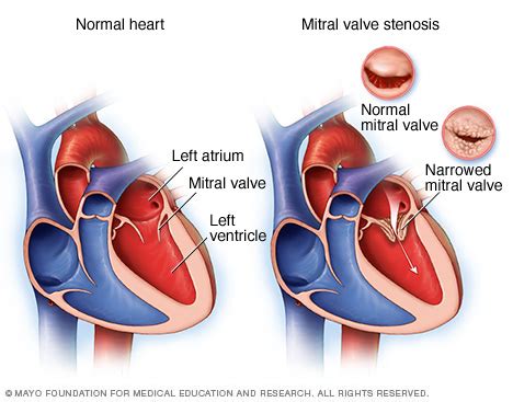 Mitral valve stenosis | Mexico| PDF | PPT| Case Reports | Symptoms | Treatment