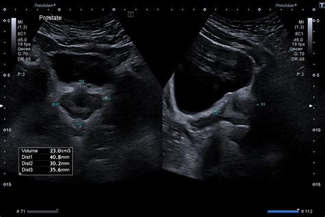 Prostate Cancer: Let's spread awareness — East Anglia Ultrasound