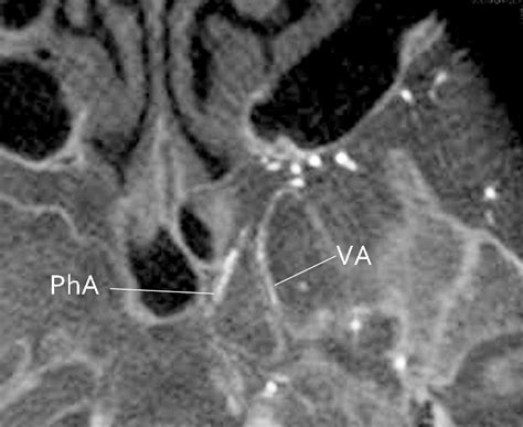 Maxillary Artery: Functional and Imaging Anatomy for Safe and Effective ...