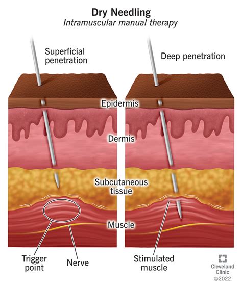 What Is Dry Needling?