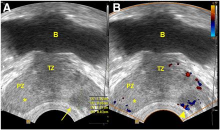 Utility of Ultrasound in the Diagnosis, Treatment, and Follow-up of Prostate Cancer: State of ...