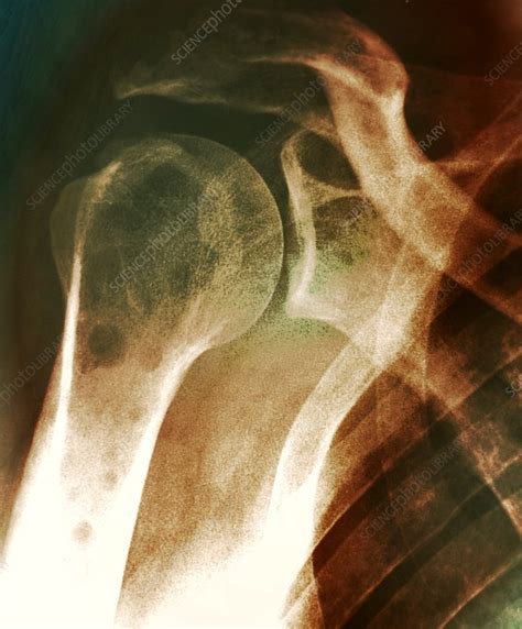 Secondary bone cancer, X-ray - Stock Image - C029/9985 - Science Photo ...