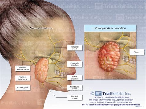 Parotid Gland Tumor - Trial Exhibits Inc.