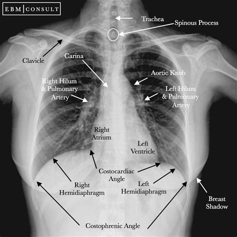 Neat How To Report Normal Chest X Ray Write A Good Introduction For Research