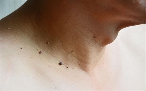 Skin Tags: Myths You Need to Stop Believing | Reader's Digest