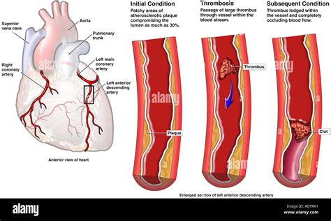 Acute Coronary Thrombosis Stock Photo: 7710064 - Alamy