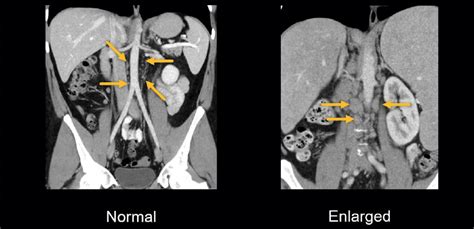 Abdominal CT: lymph nodes • LITFL • Radiology Library