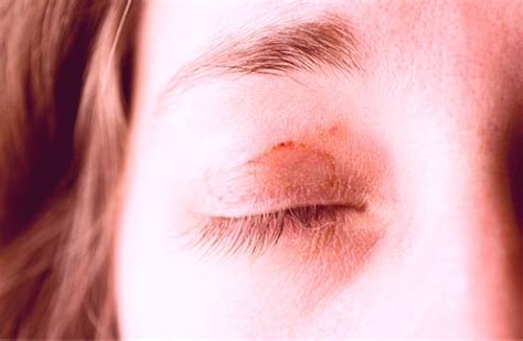 Itchy eyelids – Causes and Treatment | HubPages