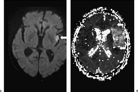 (A) A diffusion-weighted image MRI (DWI) scan shows a small stroke in ...