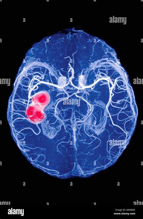 x ray of brain showing hemorrhage blood clot brain attack Stock Photo, Royalty Free Image ...