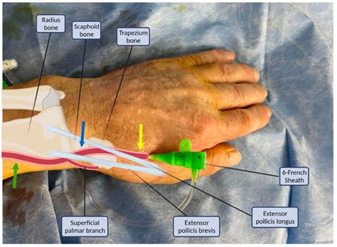 Life | Free Full-Text | The Role of Ultrasound in Accessing the Distal Radial Artery at the ...