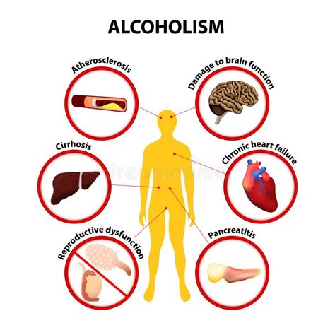 Alcoholism. infographic stock vector. Illustration of depression - 44396962