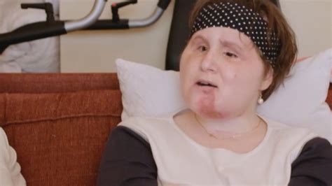 Face transplant recipient tells her story with National Geographic