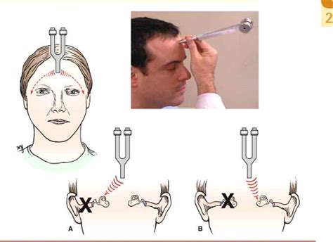 Hearing Test-Cure for Hearing Loss