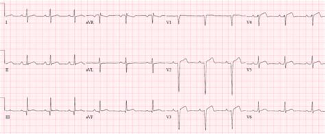 ECG Cases 14: Q-waves and Occlusion MI | EM Cases